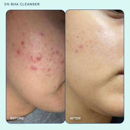 Skinfix Acne+ 2% BHA + Azelaic Acid + Niacinamide + AHA Təmizləyici