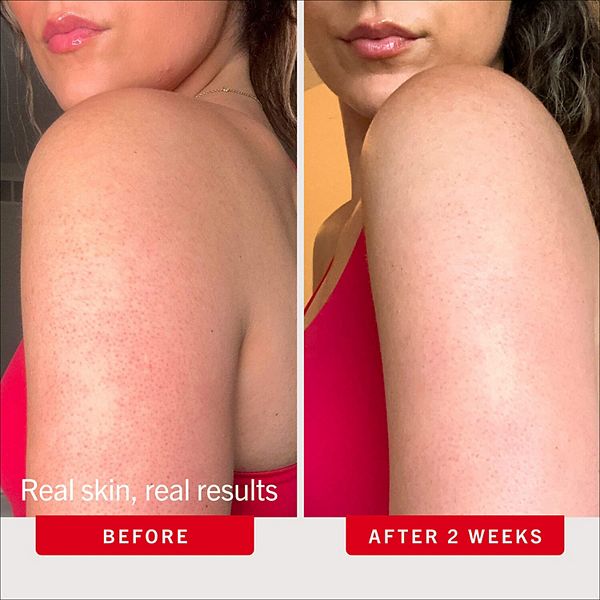 First Aid Beauty Mini KP Bump Eraser 10% AHA Bədən Eksfoliantı