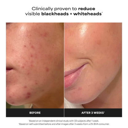 Paula's Choice Dəri Mükəmməlləşdirici 2% BHA Eksfoliant Tonik